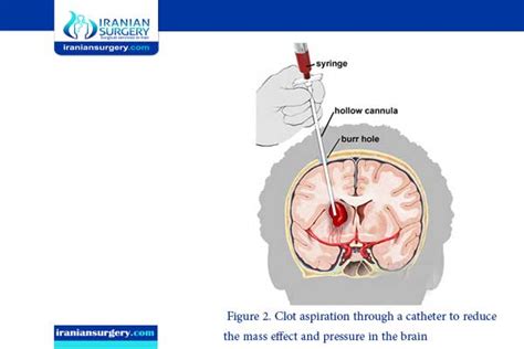 Intracerebral hemorrhage treatment | Iranian Surgery