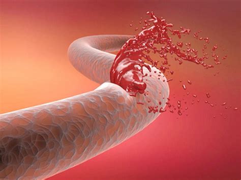 Arteriosclerosis: Symptoms, Causes, Treatment, Prevention and ...