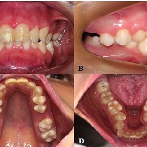 (A) Lateral view of patient #10 showing mandibular prognathism; (B)... | Download Scientific Diagram