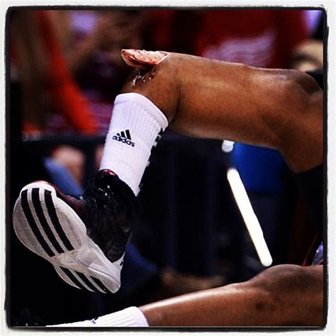 The worst basketball injury I have EVER seen in my life...… | Flickr