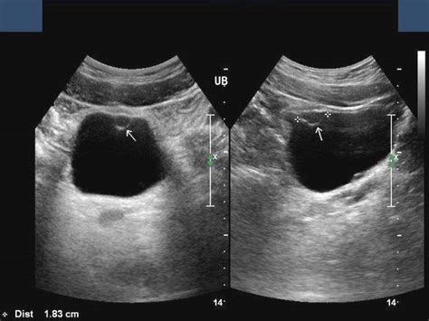 A Gallery of High-Resolution, Ultrasound, Color Doppler & 3D Images - Urinary bladder