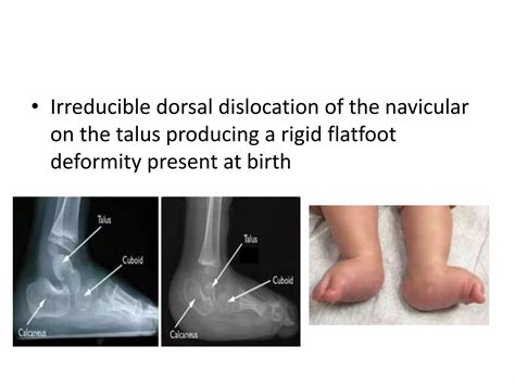 Congenital vertical talus