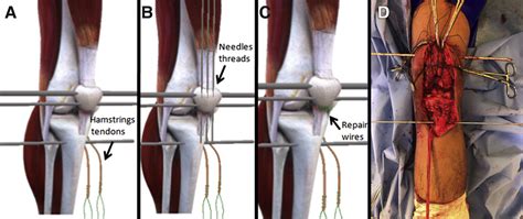 Patellar Tendon Rupture Repair