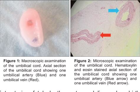 Figure 1 from Single Umbilical Artery. | Semantic Scholar