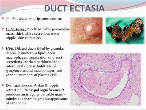 Breastbenigndisorderspathology 110914231905-phpapp01