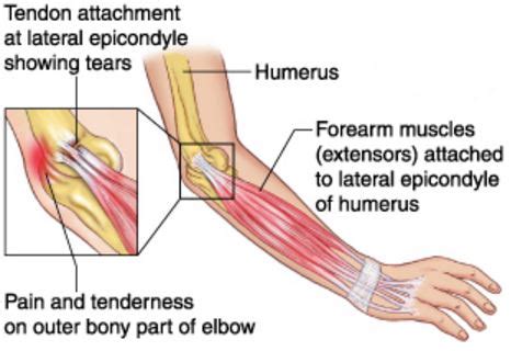 Lateral Epicondylitis - Exercises, Treatment, Test, Symptoms