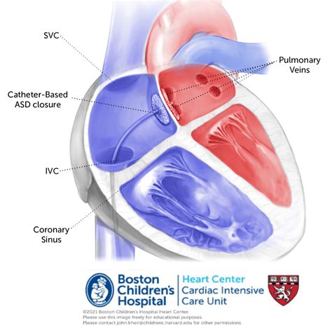 Secundum atrial septal defect – Online supplement