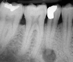 Acute Periradicular Abscess