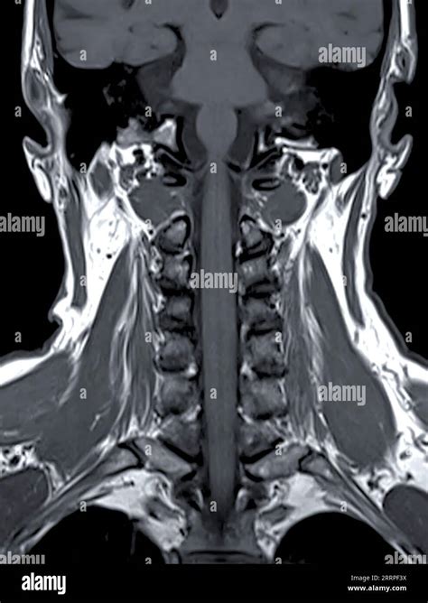 Coronal mri cervical spine hi-res stock photography and images - Alamy