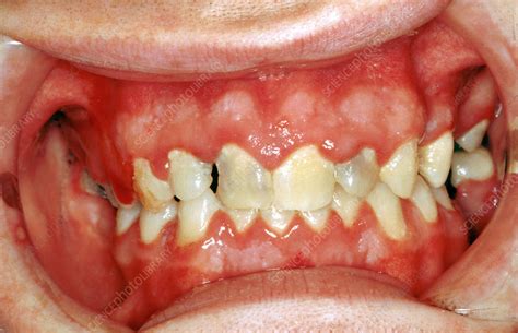 Acute Herpetic Gingivostomatitis - Stock Image - C036/5836 - Science Photo Library