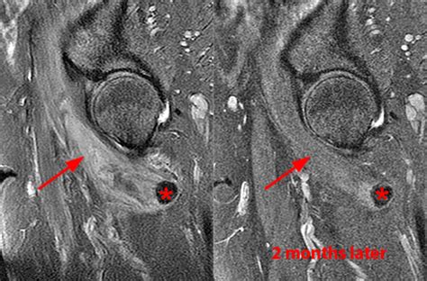 Iliopsoas Tendinopathy - Radsource