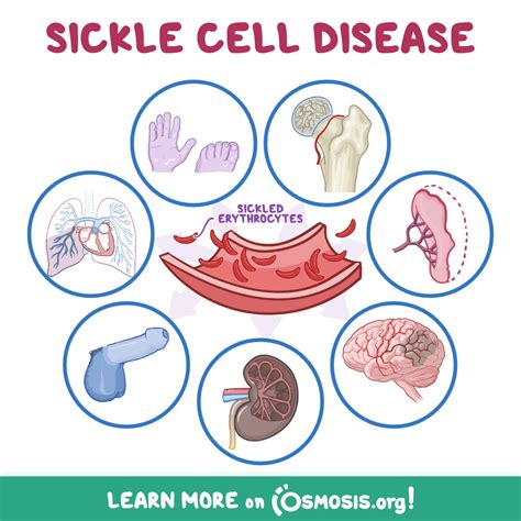 Sickle Cell Anemia Symptoms