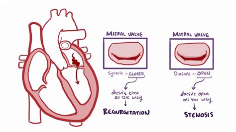 Mitral Valve Stenosis Pathophysiology