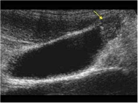 Abdomen and retroperitoneum | 1.2 Gallbladder and bile ducts : Case 1.2 ...