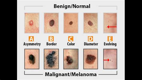 What to look for during a skin cancer self-exam | WOODTV.com