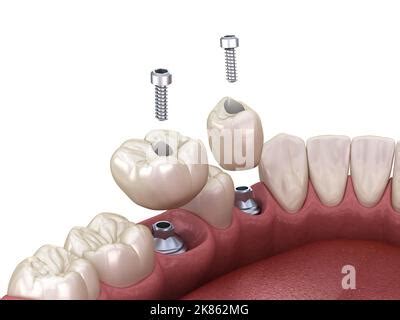 Premolar and Molar tooth crown installation over implant, screw ...