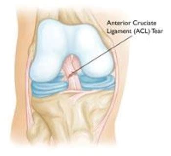 Meniscal Tear Surgery | Torn Meniscus Surgery | Bayonne | Bloomfield