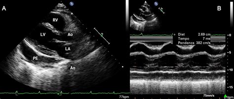 Pericardial Effusion Echo