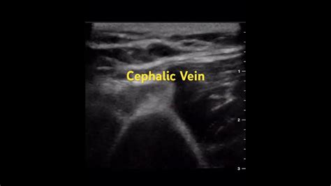 Cefalic Cephalic Céphalique Vein #anesthesia #anesthesiology #ultrasound - YouTube