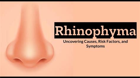 Rhinophyma Exposed: Causes, Risk Factors, and Symptoms - YouTube