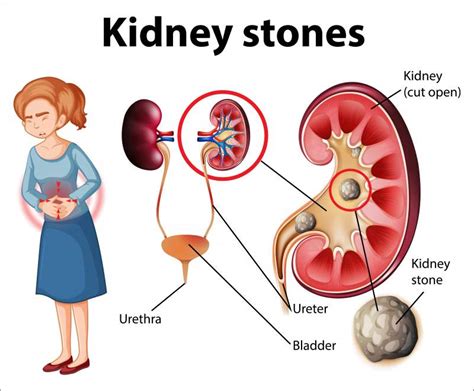 Treatment of kidney stones - Ok Healthy Living