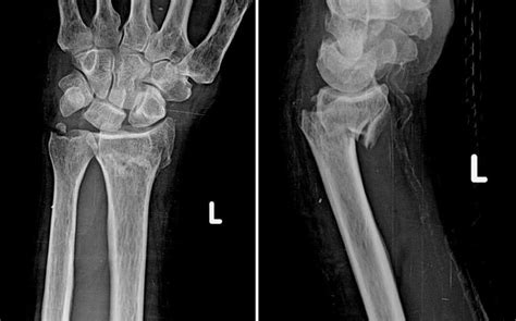 Bartons fracture ,What to know?