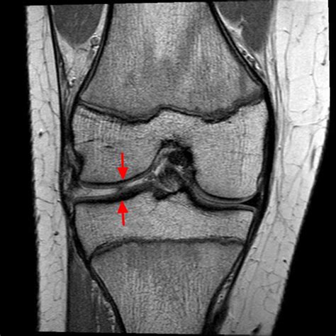 Torn Meniscus - Signs & Symptoms, Test, Diagnosis, Recovery, Treatment