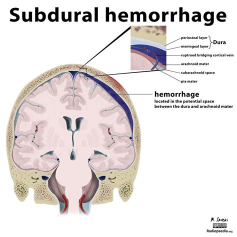 Subarachnoid Hemorrhage Vs Intracerebral Hemorrhage