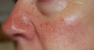 Treating Broken Blood Vessels on the Face - Laser and Skin Care MedSpa