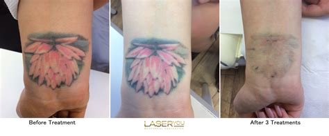 Laser Tattoo Removal Using PicoSure – LaserYou PicoSure Tattoo Removal, Skin Rejuvenation ...