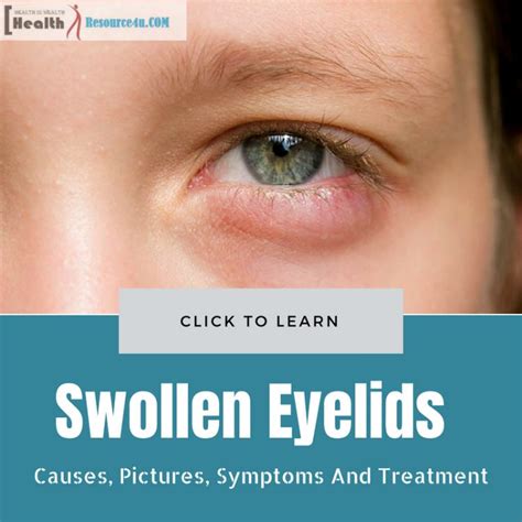 Swollen Eyelids: Causes, Pictures, Symptoms And Treatment