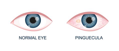 Removal of Pinguecula - Eye Center South