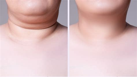 Thick Neck? Tech Neck? Why Neck Liposuction Often Fails in Younger ...