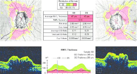 OCT of both optic nerves showing elevated optic nerve heads and ...