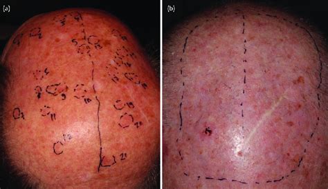 (a) Forty-seven patients had laser treatment of lesions only, followed... | Download Scientific ...