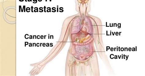 Stage 4 Pancreatic Cancer Causes Symptoms Prognosis - Survival Rates & Signs: Stage 4 Pancreatic ...