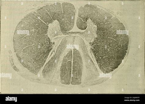 Hypoglossal nerve paralysis hi-res stock photography and images - Alamy