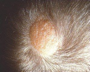 Cancerous Lumps on Scalp | Mole on scalp, Skin moles, Scalps