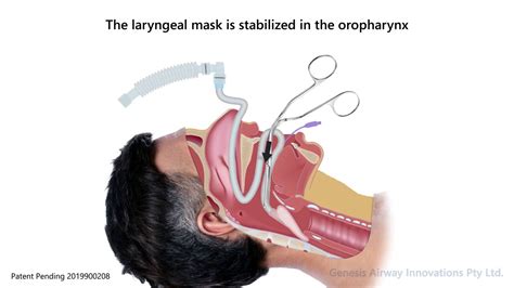 Intubating Laryngeal Mask Airway