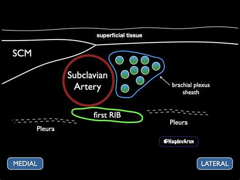 Supraclavicular Brachial Plexus — Highland EM Ultrasound Fueled pain ...