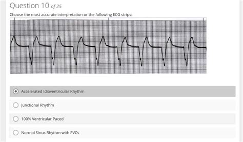 Solved Junctional Rhythm Normal Sinus Rhythm with PVCs | Chegg.com