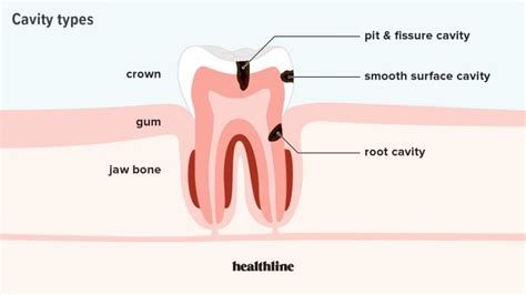 Cavities Treatment – TMJA Harmony Dental Clinic