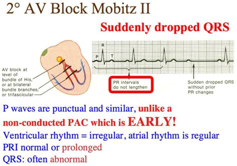 Atrioventricular Block