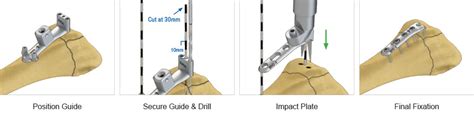 Dorsal Hook Plate - Upper Extremity Orthopedic Implants - TriMed Inc.