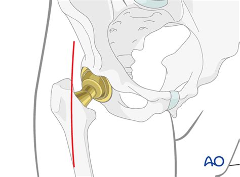 ANTERIOR APPROACH FOR TOTAL HIP REPLACEMENT