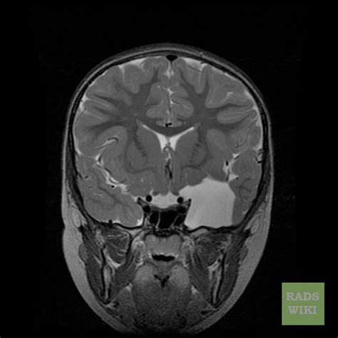 Arachnoid cyst MRI - wikidoc