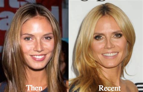 Heidi Klum Plastic Surgery Before and After Photos