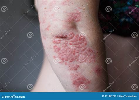 Psoriasis Skin. Psoriasis is an Autoimmune Disease that Affects the Skin Cause Skin Inflammation ...