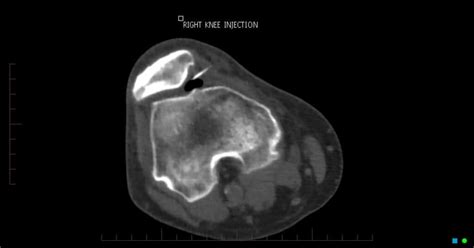 IMAGING GUIDED EUFLEXXA INJECTION FOR MANAGEMENT OF KNEE OSTEOARTHRITIS ...