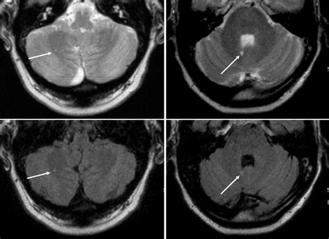 Silent Brain Lesions And Migraines